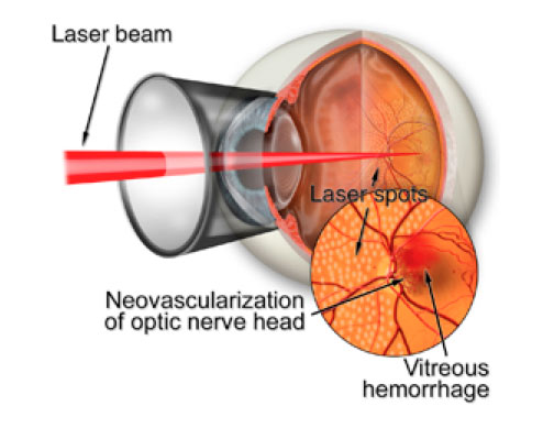 Diabetic Retinopathy Treatment: Laser Surgery Diagram | Southern Vitreoretinal Associates