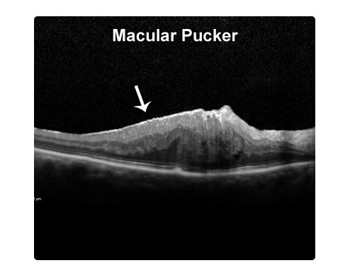 Example of the eye condition Macular Pucker | Southern Vitreoretinal Associates