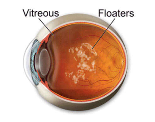 Eye Conditions: Floaters and Flashes diagram | Southern Vitreoretinal Associates