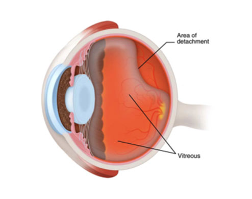 Eye Conditions: Floaters and Flashes diagram | Southern Vitreoretinal Associates