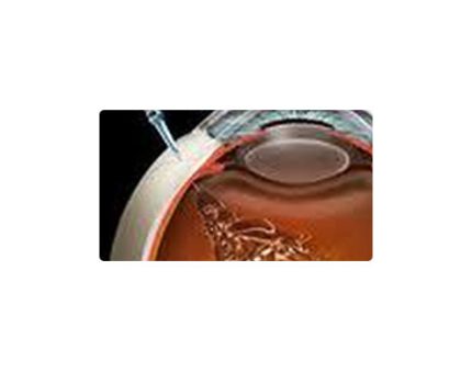 Intravitreal Injection | Southern Vitreoretinal Associates