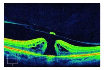 Macular Hole Stages, Informative Blog by Southern Vitreoretinal Associates