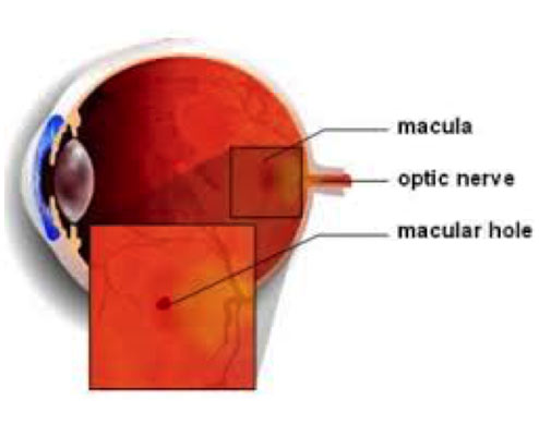Macular Hole Diagram | Southern Vitreoretinal Associates