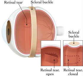 Scleral Buckle Diagram of the Eye