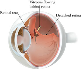 Retinal Detachment Diagram of the Eye